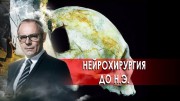 Нейрохирургия до нашей эры. Странное дело (31.12.2020)